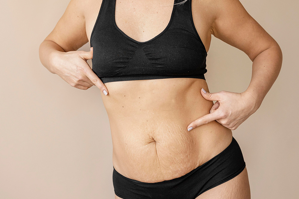 Eine Frau in schwarzer Unterwäsche und einem Sport-BH zeigt auf lockere Haut und Dehnungsstreifen auf ihrem nackten Bauch, die auf körperliche Veränderungen hinweisen. Der Hintergrund ist schlicht und neutral.